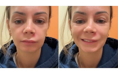 Ho schiacciato un brufolo nel triangolo della morte e ho rischiato la vita Che cos e il monito degli esperti Non fatelo pu essere letale